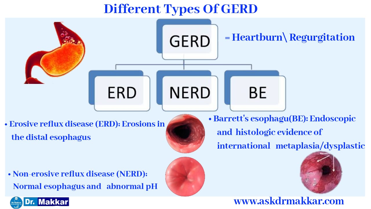 Gastro-esophageal Reflux Or GERD Treatment In Stomach With Best ...